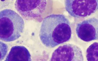 Novel NGS Assay: Making Myeloma Detection and Monitoring Accessible for any Laboratory in the World
