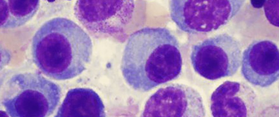Novel NGS Assay: Making Myeloma Detection and Monitoring Accessible for any Laboratory in the World